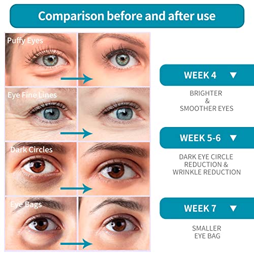 КРЕМ ЗА ОЧИ С ХИАЛУРОНОВА КИСЕЛИНА LANBENA - За лечение на отоци под очите и тъмните кръгове – вид на кожата и намалява