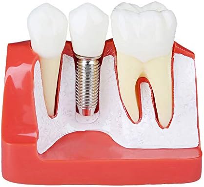 Демонстрационен модел на зъбите с Зубным имплантат KH66ZKY Модел на зъби - Анализ на импланти Демонстрационен Модел на зъбите с Корончатым мост за обучение