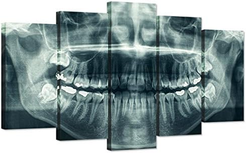 iHAPPYWALL Модерен 5-Панел Платно Стенно Изкуство Рентгенов Стоматологичен Зъб Орален Панорамна Снимка на Кариес Печат за Зъболекарски кабинет Опъната и Ограден за Дне